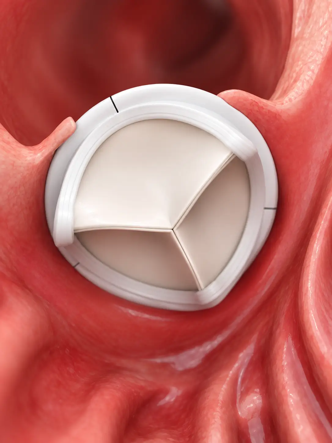 A transcatheter heart valve frame against a dark ground
